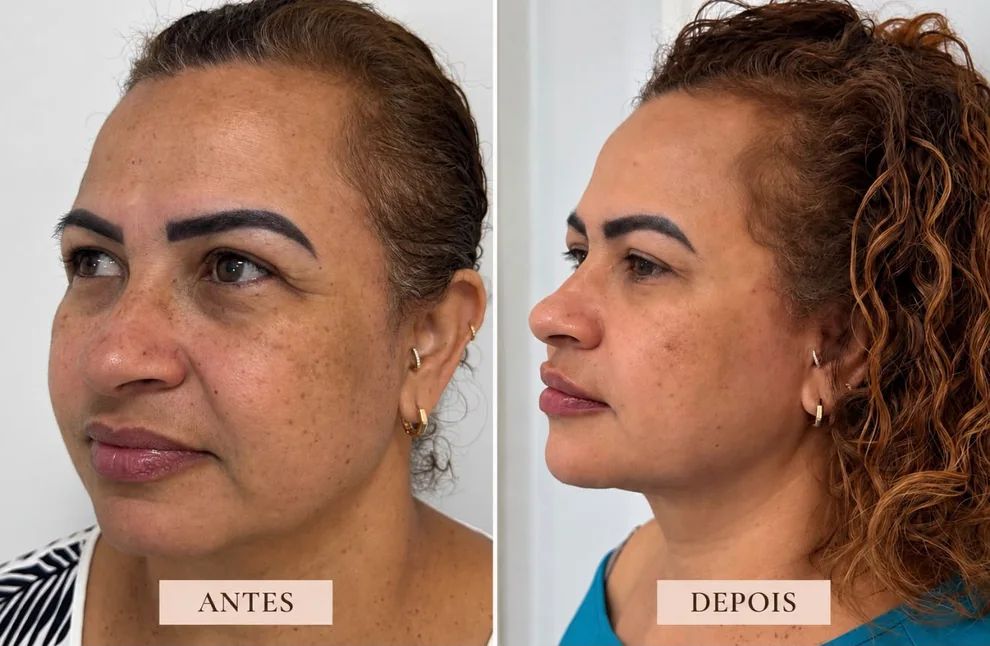 Antes e depois, de perfil: Protocolo Essência Elleve