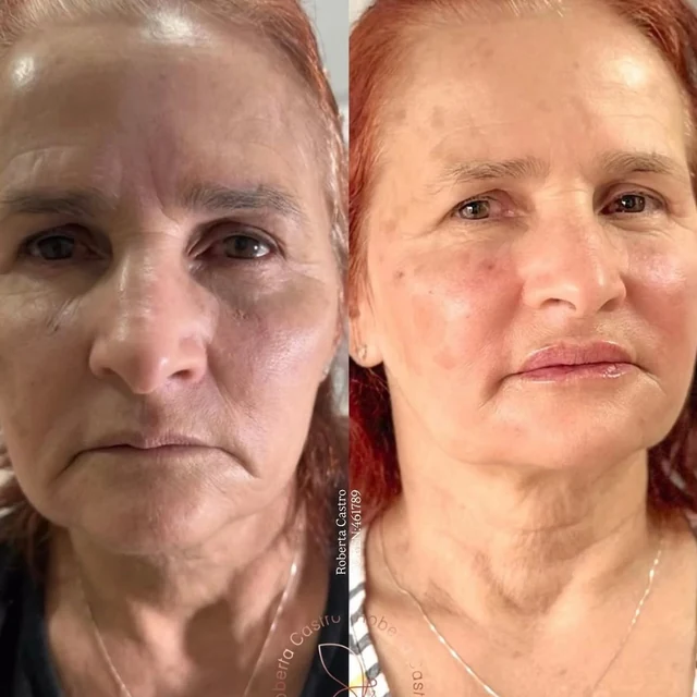 Antes e depois, qualidade da pele: Protocolo Essência Elleve