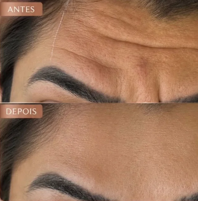 Antes e depois: tratamento do terço superior