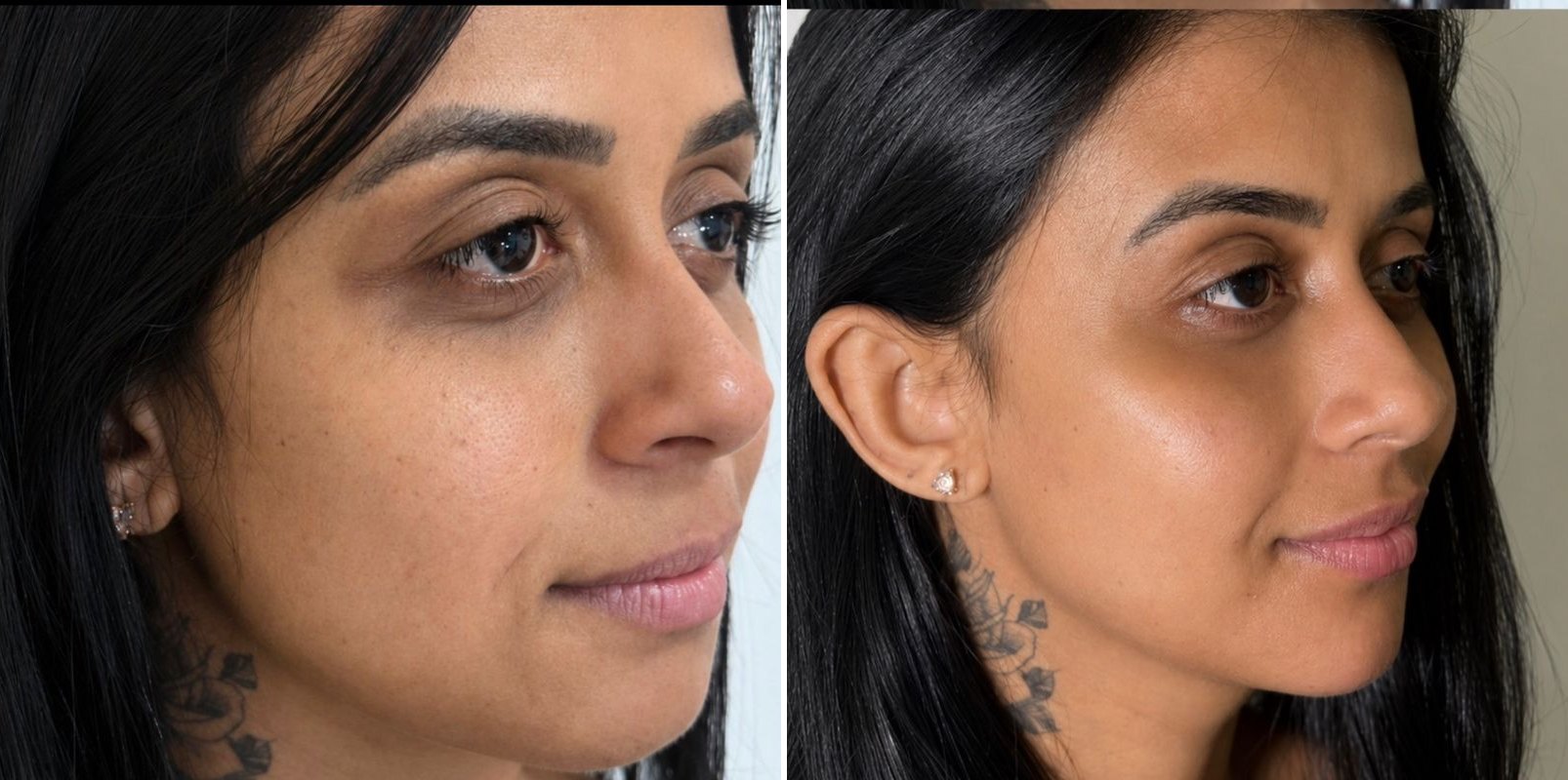 Antes e depois: Rejuvenescimento facial, estética avançada em Governador Valadares/MG