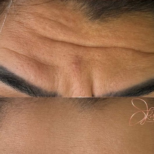 Antes e depois: Linhas da testa, estética avançada em Governador Valadares/MG