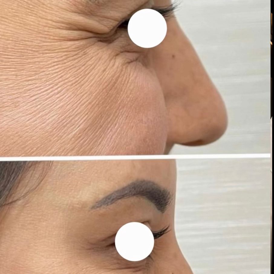 Antes e depois: Linhas ao redor dos olhos, estética avançada em Governador Valadares/MG