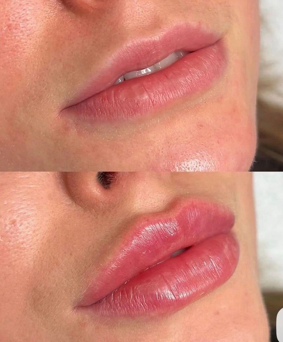 Antes e depois: Lábios, estética avançada em Governador Valadares/MG