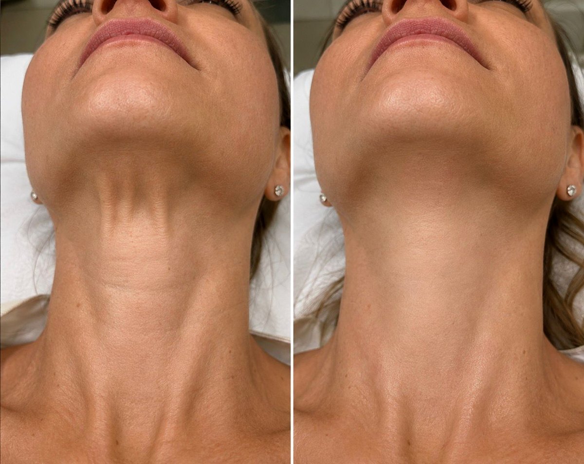 Antes e depois: Pescoço e bandas, estética avançada em Governador Valadares/MG
