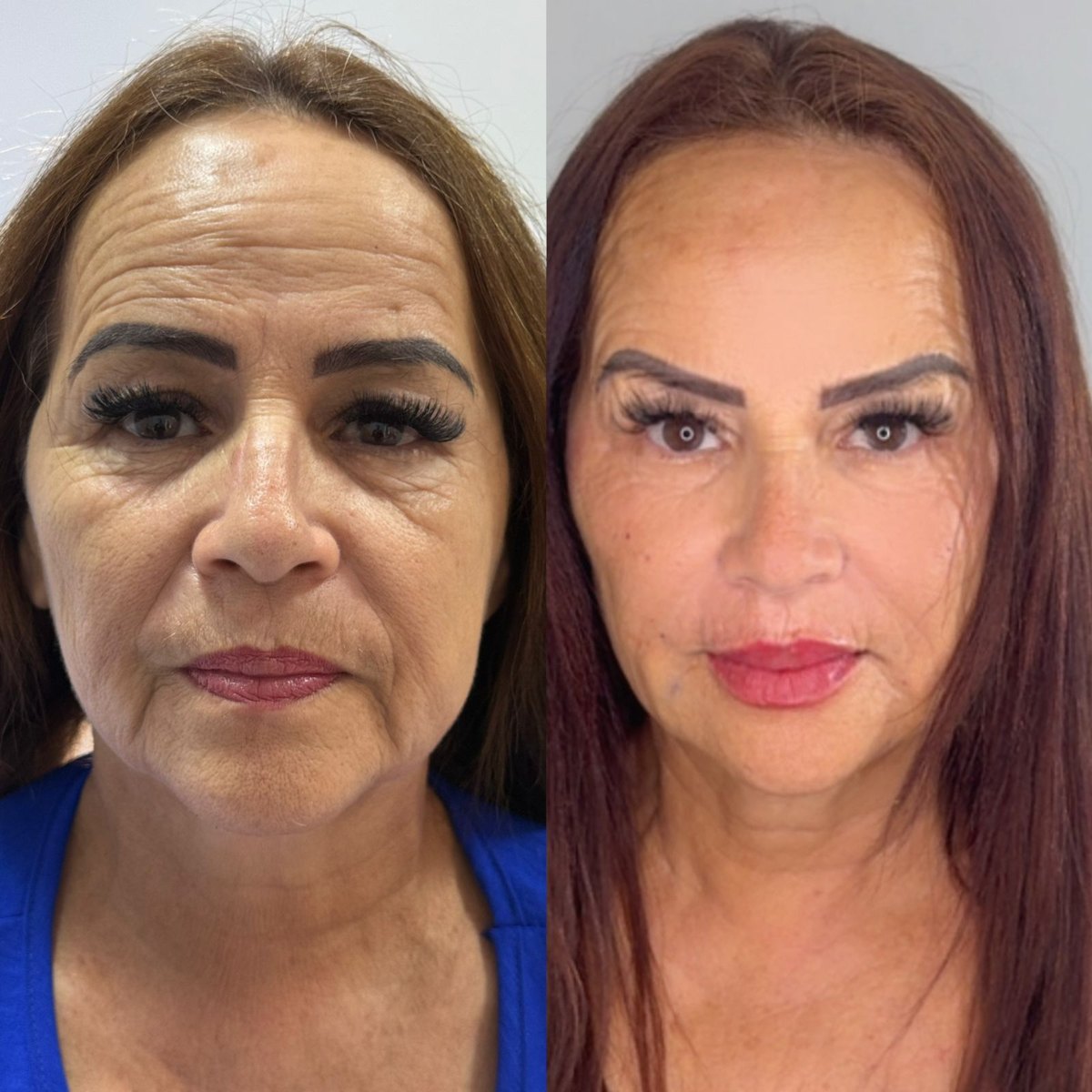 Antes e depois: Rejuvenescimento facial completo, estética avançada em Governador Valadares/MG