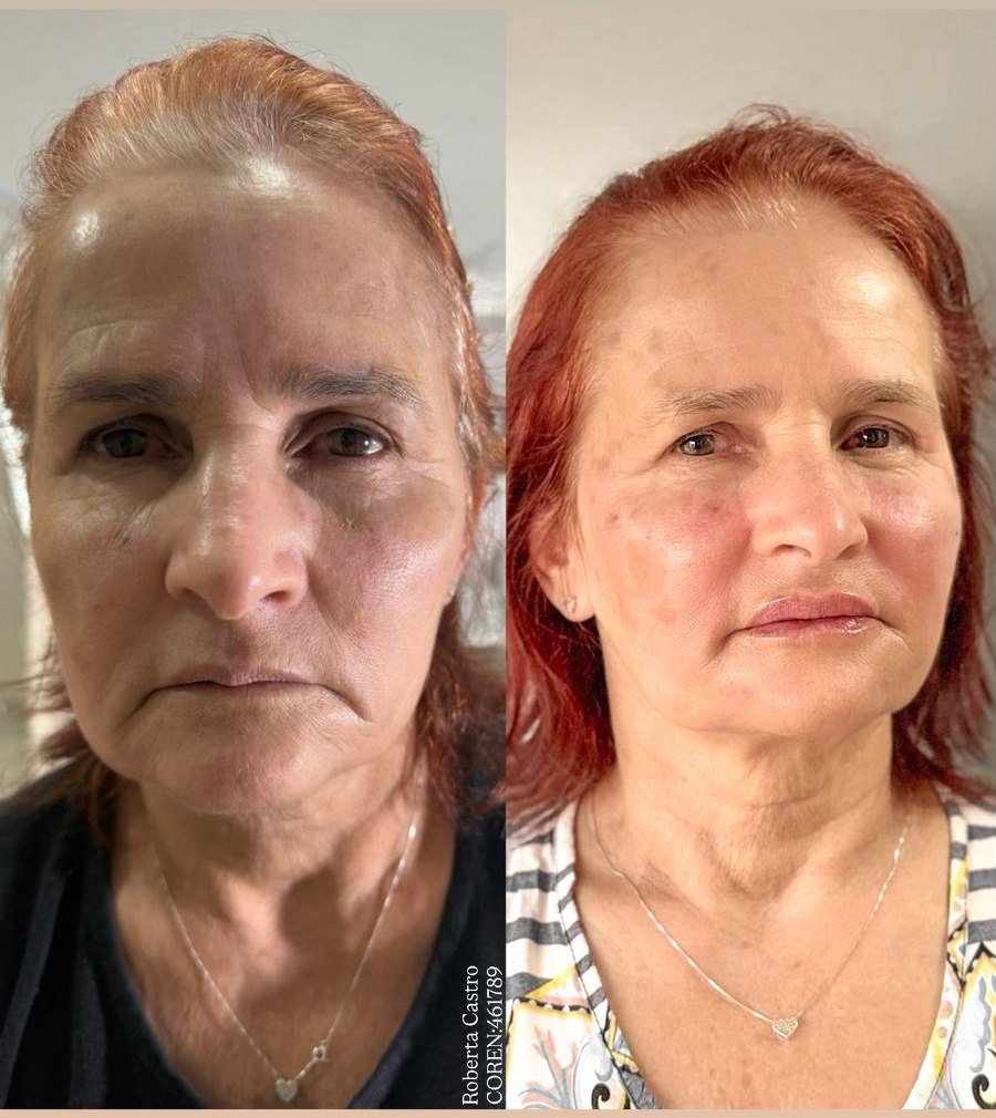 Antes e depois: Rejuvenescimento e qualidade da pele, estética avançada em Governador Valadares/MG
